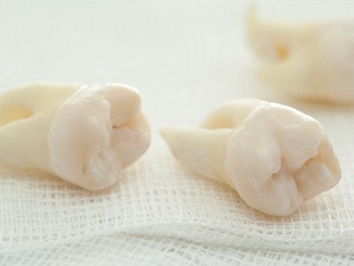 智齒疼了，這牙非拔不可嗎？