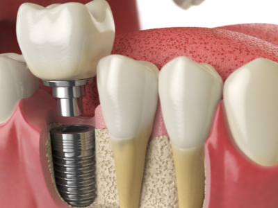 選擇種植牙后要做哪些日常維護(hù)？