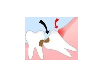 吃完飯后老塞牙？別大意！這可能是你的牙齒在報警