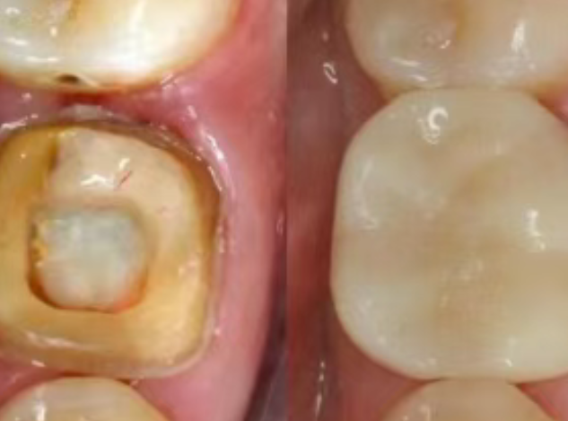 根管治療（抽神經(jīng)）后，為什么一定要做牙冠？