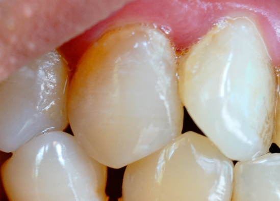 牙齒表面的牙釉質(zhì)掉了還可以修復(fù)嗎？