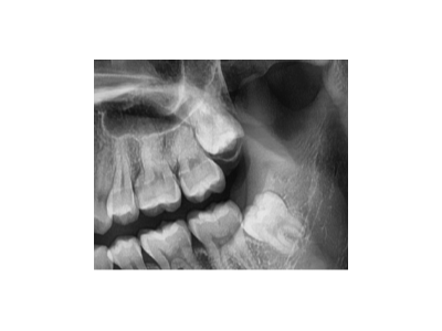 既然「智齒」不宜久留，為什么不能一次性拔掉？