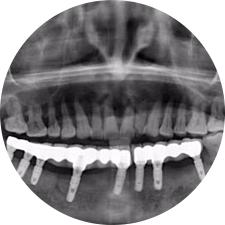 數(shù)字化導(dǎo)板提高種植準確度