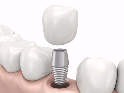 在承德哪家口腔醫(yī)院口腔種植齒好一點，惟德口腔醫(yī)院值得您的選擇