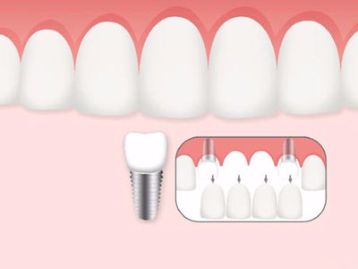 惟德口腔口腔種植怎么樣？惟德口腔就來為您一一解答