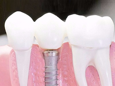 在承德口腔種植齒需要多少錢(qián)？惟德口腔一一為您道來(lái)