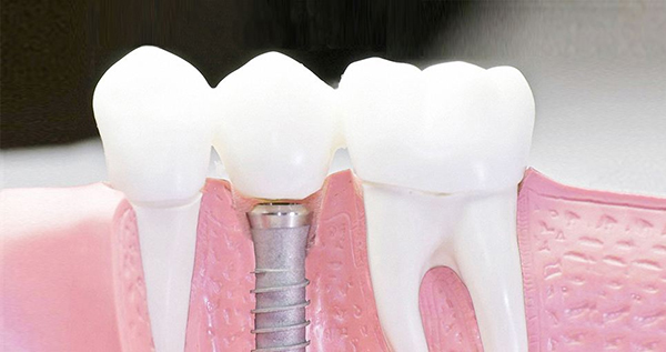 在承德口腔種植牙齒需要多少錢？惟德口腔一一為您道來(lái)