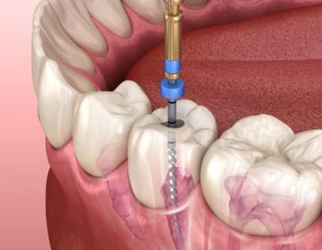 根管治療后的注意事項有哪些？